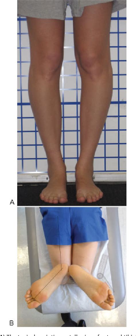 tibial torsion test normal range|external tibial torsion in adults.